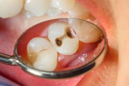 BABIO Launches Advanced Caries Enrichment Medium for Early Tooth Decay Detection